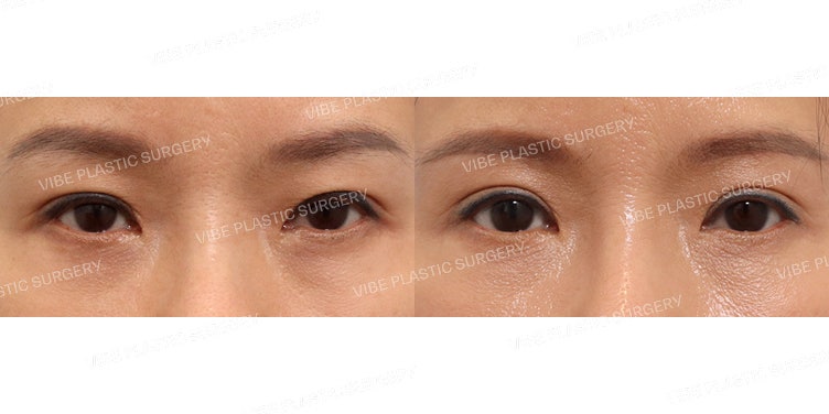 Sub-brow Lift and Natural Adhesion (Revision Surgery)