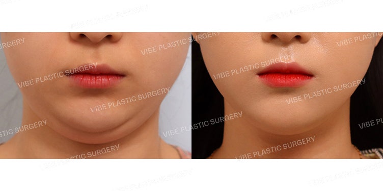 Ultrasound Facial Liposuction (Liposound)