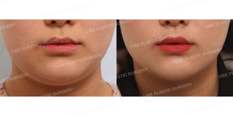 ดูดไขมันเหนียงแบบไม่ผ่าตัด (Non-incisional Double Chin Liposuction)
