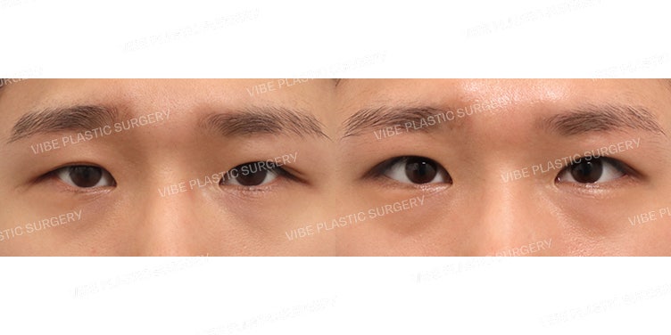 Chỉnh sửa sụp mí mắt một mí cho nam (Phẫu thuật lại)