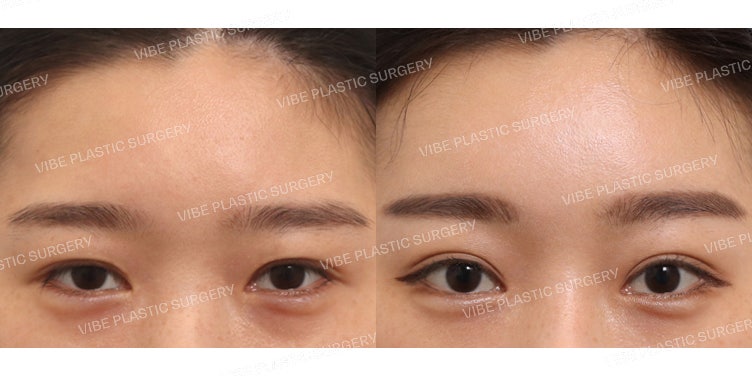 Do Your Eyes Look Heavy and Pressed? Endoscopic Brow Lift and Incisional Ptosis Correction (Revision)