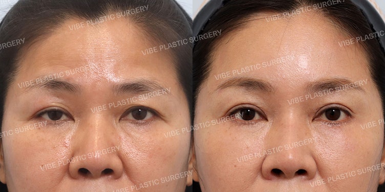 Natural Middle-Aged Eye Surgery (Endoscopic Forehead Lift, Ptosis Correction, Lower Blepharoplasty)
