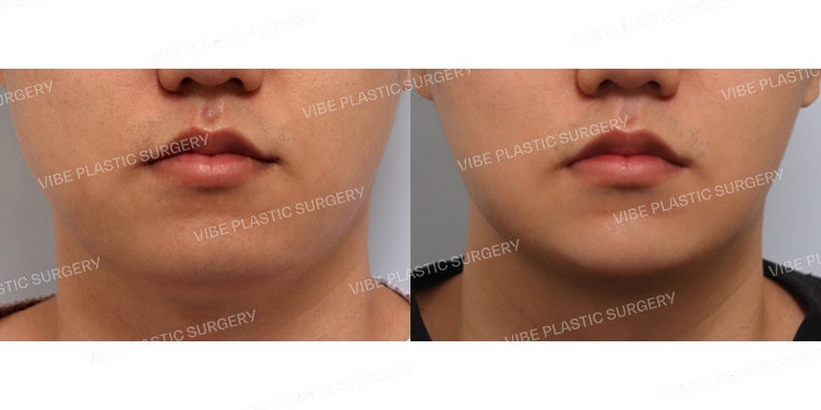 VIBE Plastic Surgery - LipoSound (ดูดไขมันด้วยคลื่นเสียงความถี่สูง)