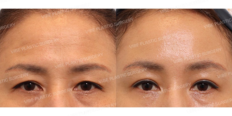 Natural Middle-Aged Eye Surgery! Smoothing Out Forehead Wrinkles is a Bonus ^^