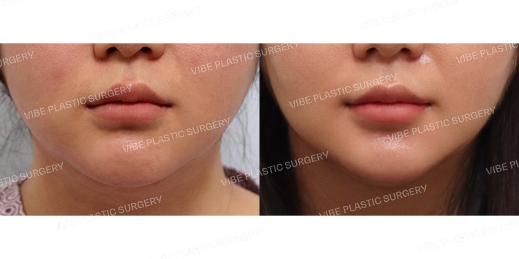 LipoSound Liposuction (Revision Surgery)