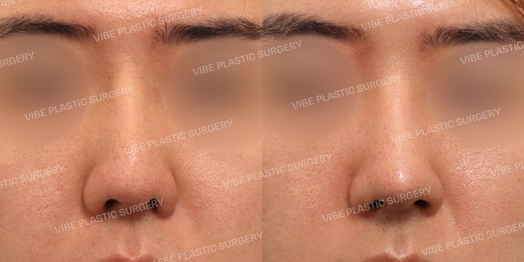 عملية إعادة تجميل الأنف للرجال!