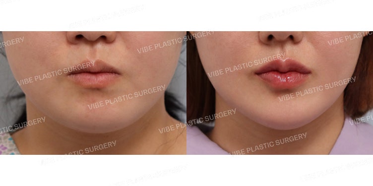 Creating a Natural V-Line Without Facial Contouring Surgery!
