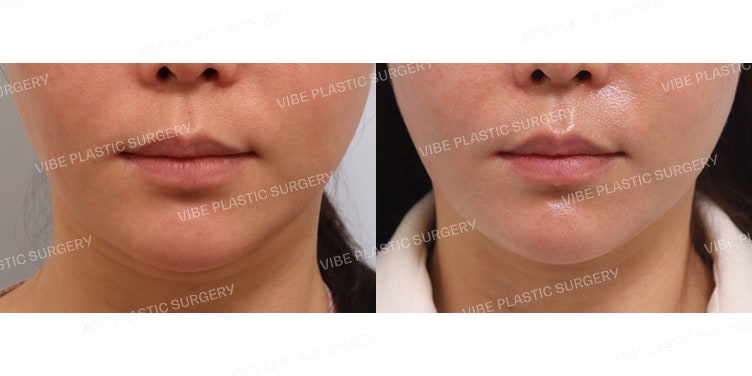 Highly Effective! LipoSound Liposuction!