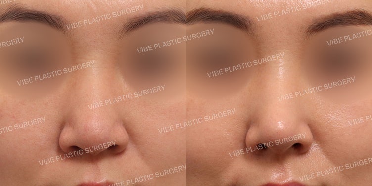 عملية تجميل الأنف بدون غرسات في عيادة فايب للتجميل