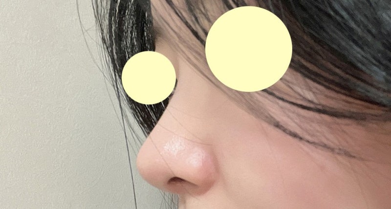 Phẫu thuật mũi không dùng vật liệu độn tại Bệnh viện Thẩm mỹ VIBE