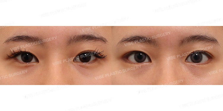 Phẫu thuật Mango-teum tại Vibe (Mở rộng đuôi mắt và hạ góc mắt ngoài)