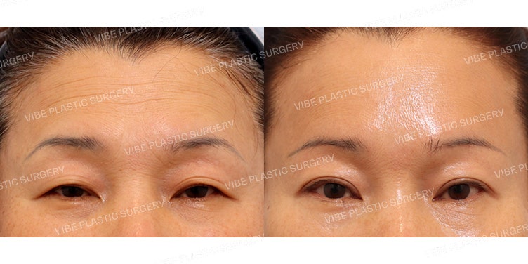 Natural Results are Key! Middle-Aged Eye Surgery (Endoscopic Brow Lift, Subbrow Lift, Natural Adhesion)