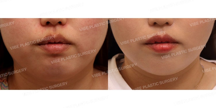 Say Goodbye to a Dull Jawline! LipoSound Liposuction