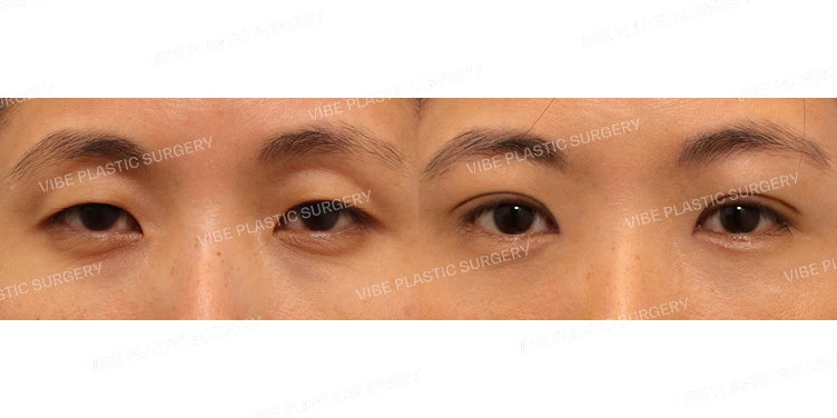 Giải pháp cho hốc mắt trũng sâu và đôi mắt lờ đờ buồn ngủ?!