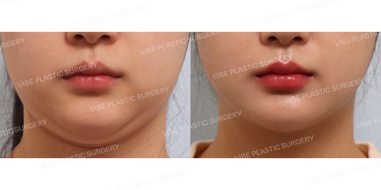 The Effectiveness of LipoSound Liposuction