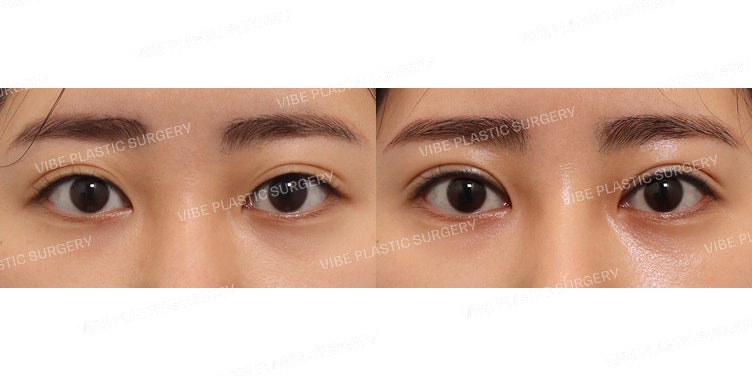 Tạo nếp mí sắc nét bằng phương pháp cắt mí (Phẫu thuật lại)!