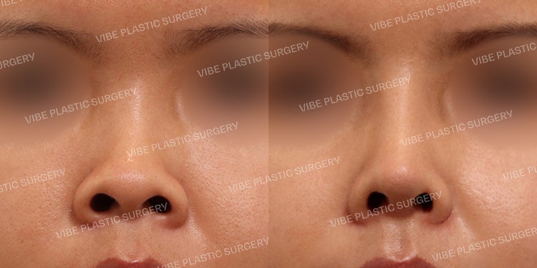 Short Nose Rhinoplasty