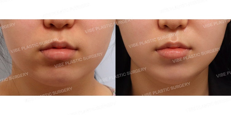 The Effectiveness of LipoSound Liposuction!!