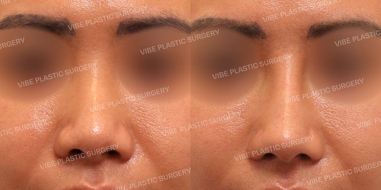 ปรับแก้จมูกชมพู่ (Bulbous Nose) เพื่อใบหน้าที่ดูโฉบเฉี่ยวและทันสมัย :D