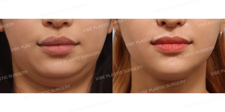 Achieve a Slim Face Shape with LipoSound!