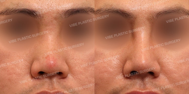 Male Bulbous Nose Rhinoplasty