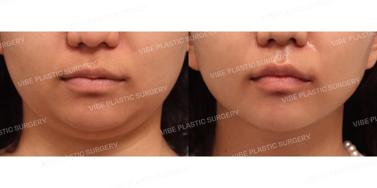กรอบหน้าเรียวสวยที่ VIBE Plastic Surgery!