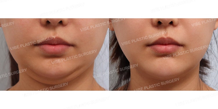 The Effects of LipoSound at VIBE Plastic Surgery!