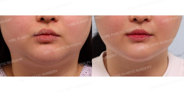 Achieve a Slimmer Face with LipoSound!
