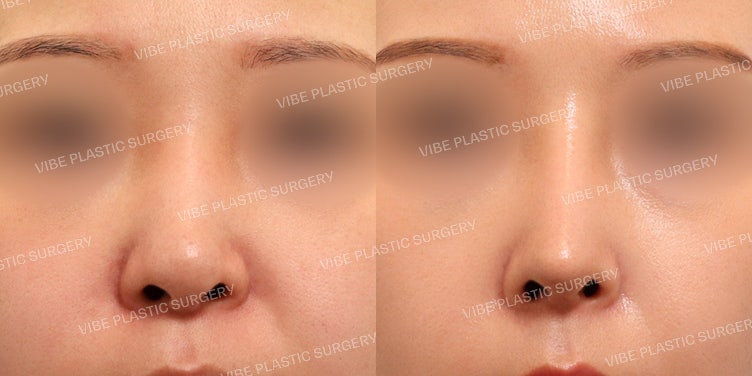 Rhinoplasty Revision at VIBE Plastic Surgery!
