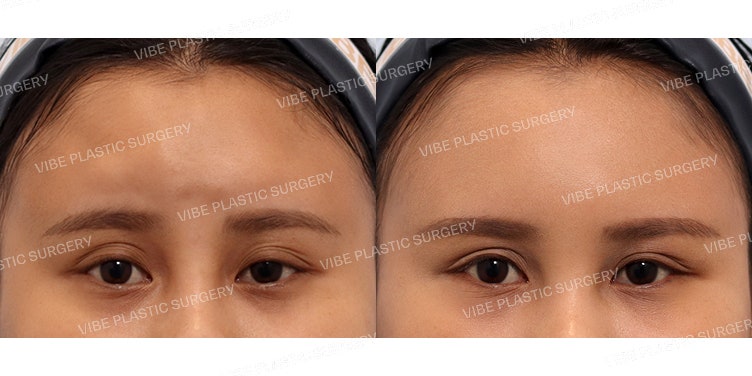 Versatile Uses of LipoSound: Resolving Unevenness After Fat Grafting