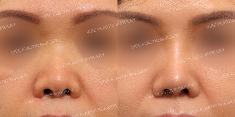 ศัลยกรรมจมูกสั้นที่ Vibe Plastic Surgery!