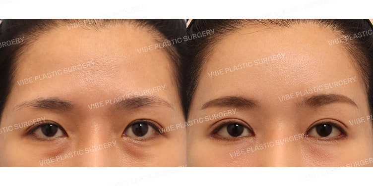 Incisional Double Eyelid Surgery and Under-Eye Fat Repositioning