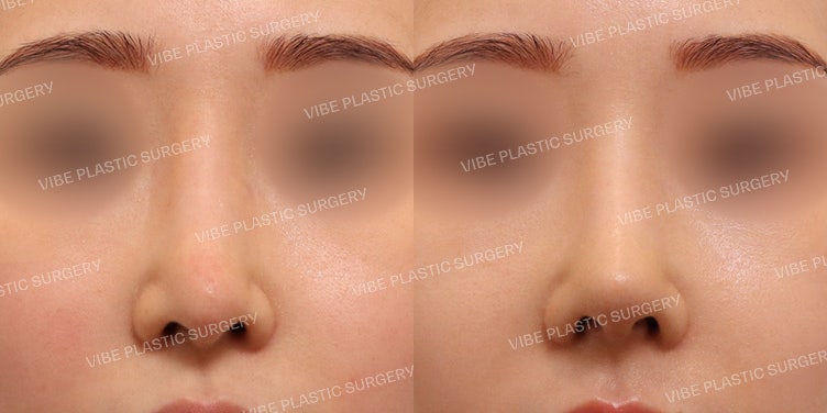 VIBE Plastic Surgery: การแก้จมูกครั้งที่ 3