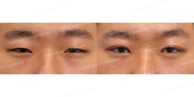 Male Ptosis Correction