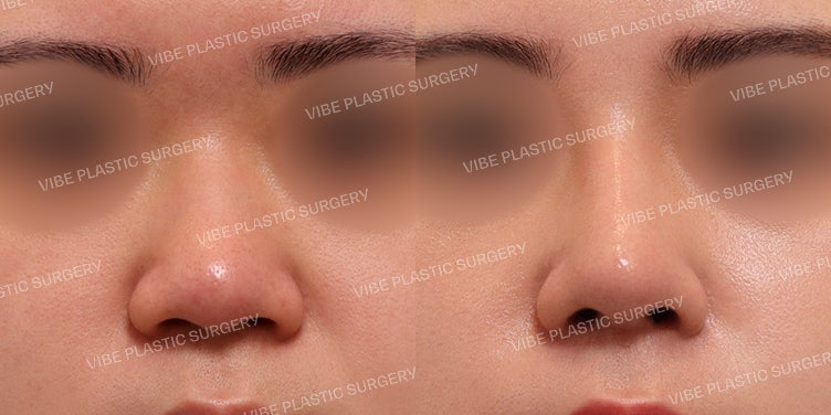 Operasi Hidung Bulat (Bulbous Nose) yang Alami tapi Glamor di Vibe Plastic Surgery :)
