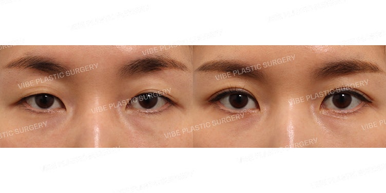Phẫu thuật thẩm mỹ mắt ở độ tuổi 30 (Đường mí In-out tự nhiên)