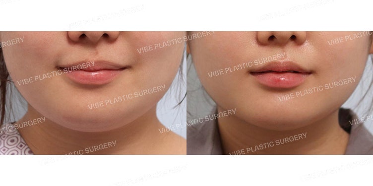ผลลัพธ์การดูดไขมันใบหน้าด้วย LipoSound ที่ VIBE Plastic Surgery!