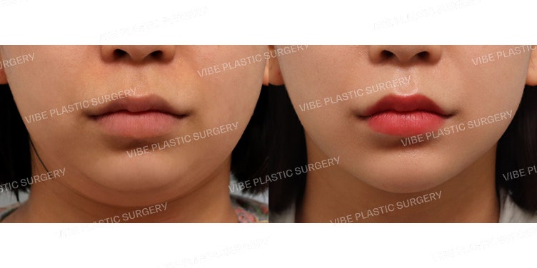 Hoàn thiện đường nét V-line với LipoSound !!