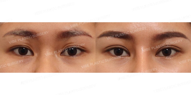 جراحة الجفن المزدوج بالشق الجراحي (+ إعادة توزيع الدهون)