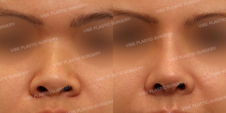 ศัลยกรรมจมูกแบนและจมูกชมพู่ที่ VIBE Plastic Surgery!
