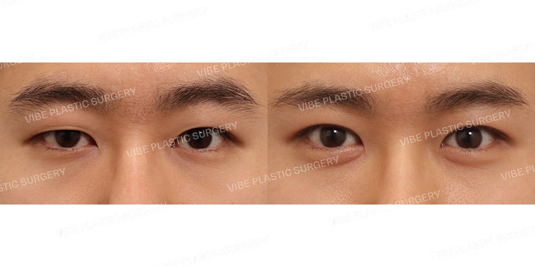 แก้ไขตาไม่เท่ากันในผู้ชาย