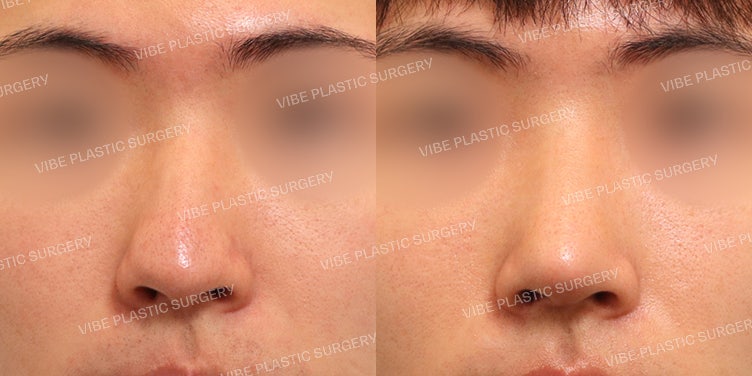عملية تجميل الأنف للرجال بدون غرسات صناعية!