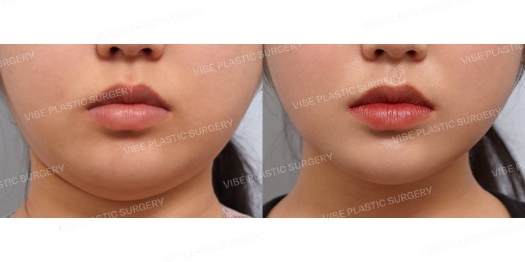 Achieve a Slim Jawline with LipoSound! (Buccal Fat Removal, Salivary Gland Botox)