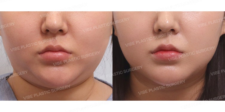 ถอดแมสก์โชว์หน้าเรียวสวย! เคล็ดลับการปรับรูปหน้าให้ดูเพรียว