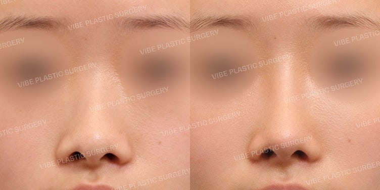 Operasi Hidung Rendah (Rhinoplasty)