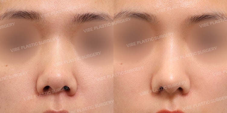 Short Nose Revision Surgery!