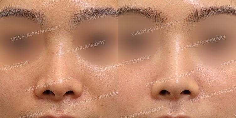 Revision Rhinoplasty for L-Shaped Implant!
