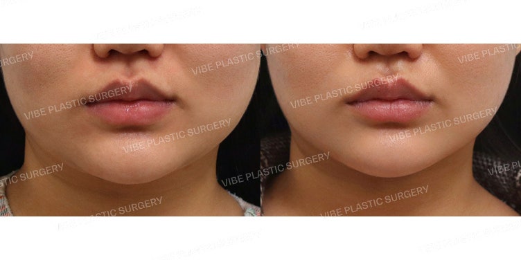 The Amazing Effects of LipoSound!
