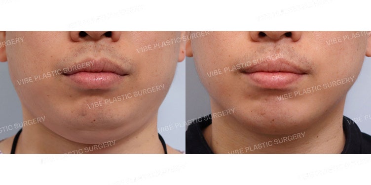 ดูดไขมันผู้ชายก็ทำได้! ที่ VIBE Plastic Surgery ~