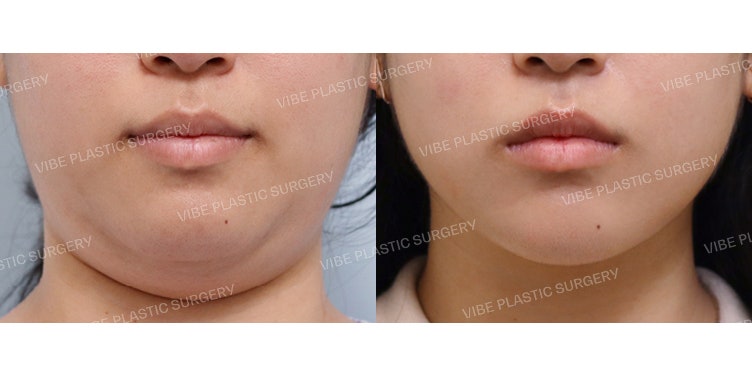 Experience the LipoSound Effect at VIBE Plastic Surgery :D